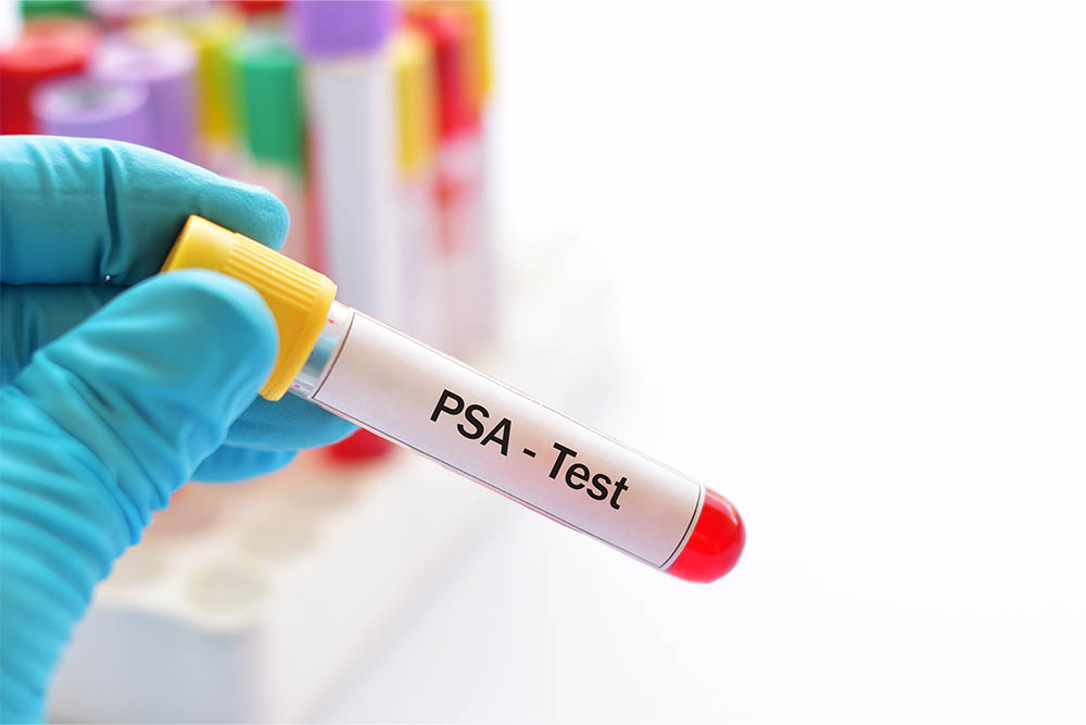 A PSA test